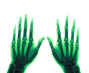X-Ray Hands ( front view ) : Normal human hands