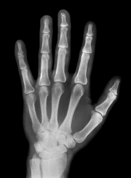 Scanned real x-ray film image of a male hand.