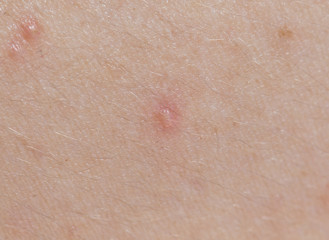 Naklejka premium pimples on the skin. close