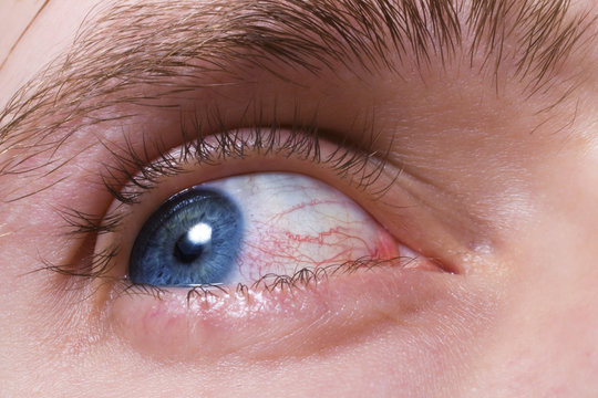 blue men eye with red blood vessels