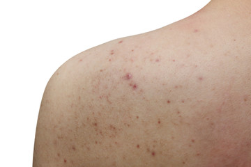 isolated acne on a man back