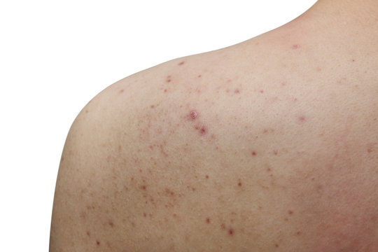 Isolated Acne On A Man Back