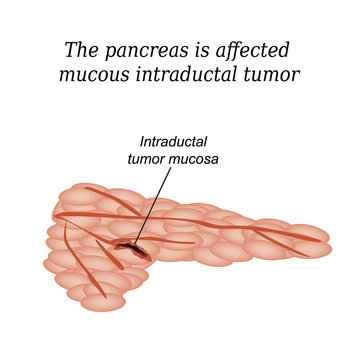 The pancreas is affected mucous intraductal tumor. Vector
