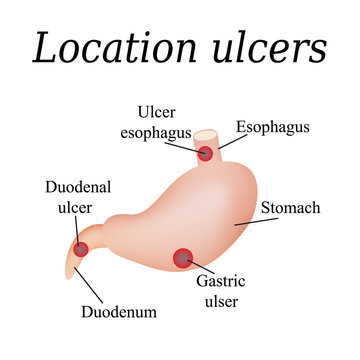 Esophagus Ulcer Affected. Ulcer Of Esophagus. Stomach Ulcer