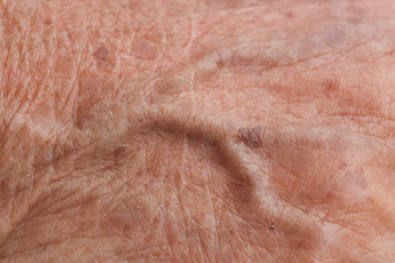 old woman skin blood vessel