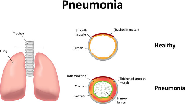 Pneumonia Illustration