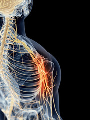 medically accurate illustration - painful shoulder nerves