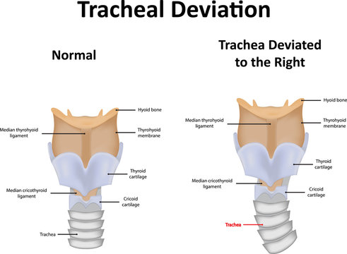 Tracheal Deviation