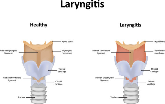 laryngitis diagram