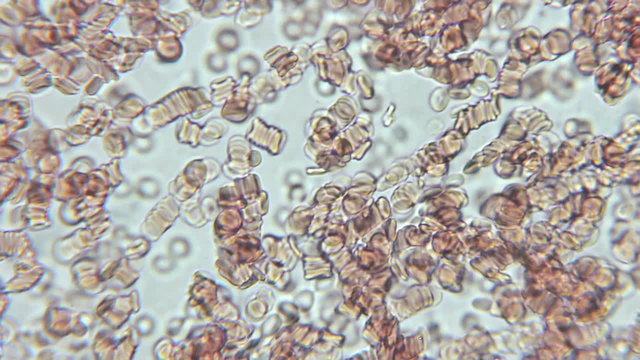 Red Blood Cells and Platelets clumping together on microscope view.