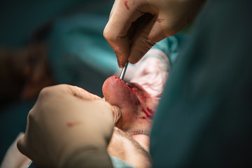 Plastic surgery of the nose in men, rhinoplasty.