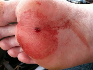 Nail puncture wound