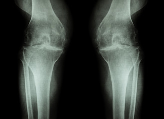 Osteoarthritis Knee ( OA Knee ) ( Film x-ray both knee with arthritis of knee joint : narrow knee...
