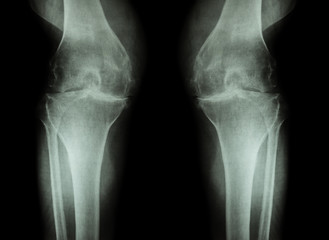 Osteoarthritis Knee ( OA Knee ) ( Film x-ray both knee with arthritis of knee joint : narrow knee joint space ) ( Medical and Science background )