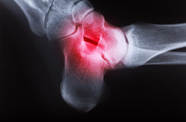 x-ray image of human foot joint , side view