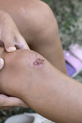 Scraped knee