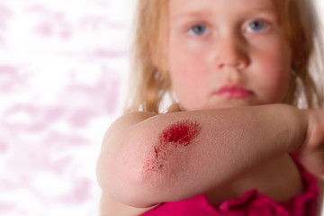 Sportverletzung - schmerzhafte Wunde am Ellenbogen