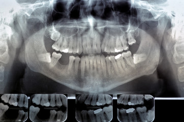 Dental radiography  Digital x-ray teeth scan of adult male - obrazy, fototapety, plakaty