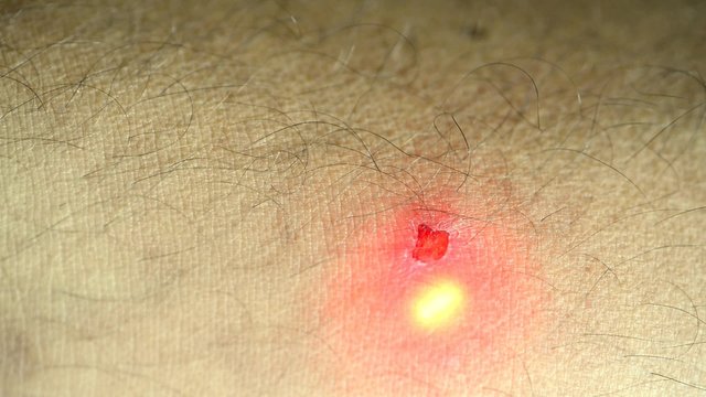 Wundbehandlung mit Soft-Laser am menschlichen Arm
