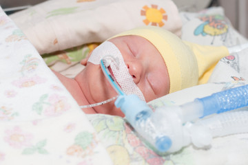Новорожденный под аппаратом искусственного дыхания