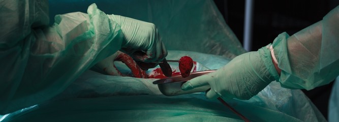 Surgeon cutting out a tumor - obrazy, fototapety, plakaty