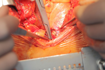 Cardiovascular operation macro