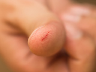 Thumb cut wound