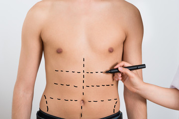 Person Hands Drawing Correction Lines On Abdomen