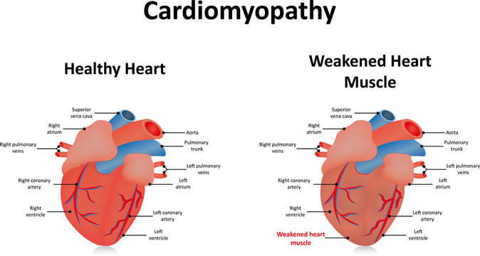 Cardiomyopathy Illustration