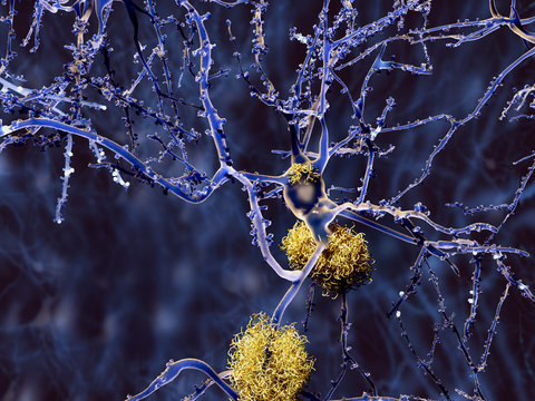 Alzheimer: Neuron mit Amyloid-Plaques