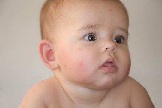 Baby mit M&uuml;ckenstichen im Gesicht