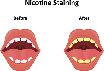 Nicotine Staining