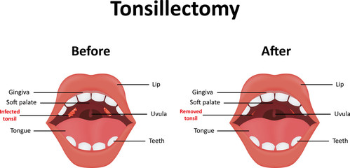 Tonsillectomy Illustration