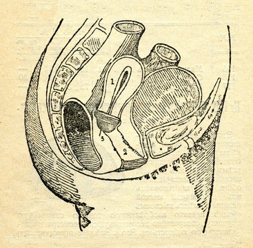 Contraceptive Cervical Cap From 1900s