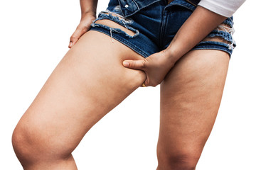 Fat thighs, cellulite of a teenage girl. - obrazy, fototapety, plakaty