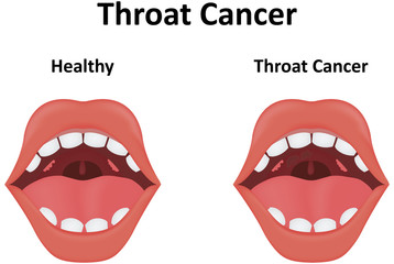 Throat Cancer Illustration