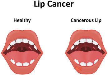 Fototapeta premium Lip Cancer Illustration