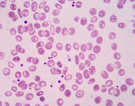 Blood picture patient Thalassemia.