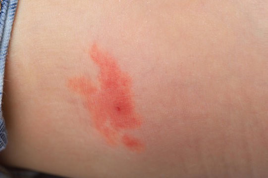 entz&uuml;ndete Schwellung nach Insektenstich