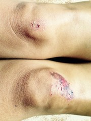 Fototapeta premium wounds on the knees