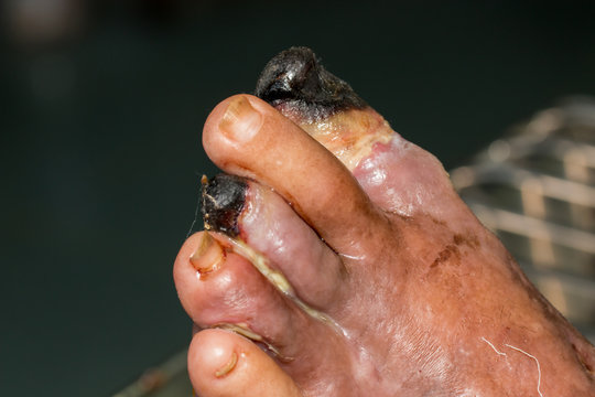 wound of diabetic foot