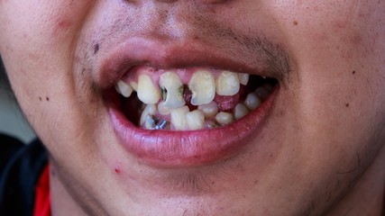 Uncared Denture before Dental Treatment.