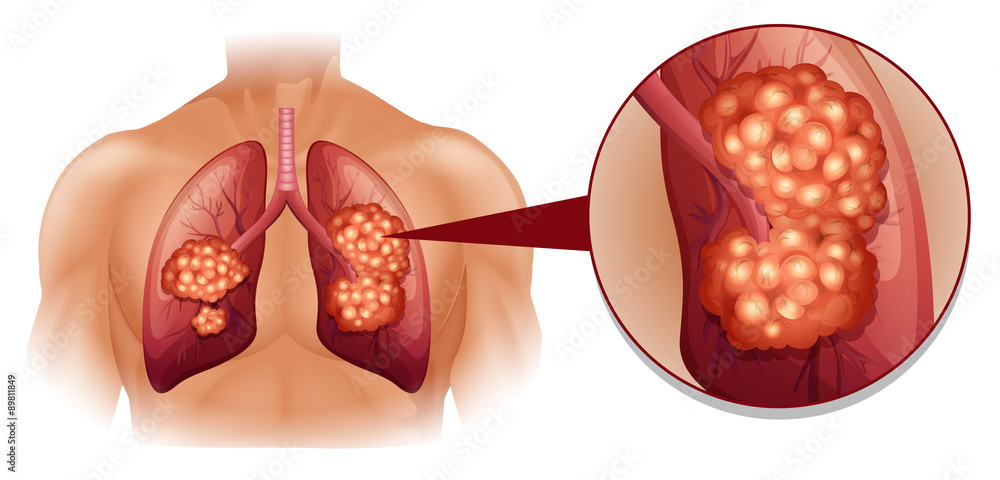 Poster Lung cancer diagram in details