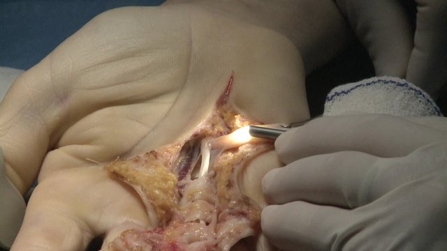 surgery in an operating room/Use of a contact endoscope and record HD
