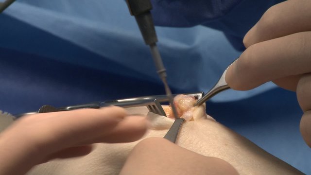 surgery in an operating room/update of a cyst in the wrist
