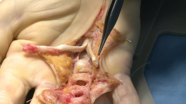 surgery in an operating room/pulleys under which the tendon slides
