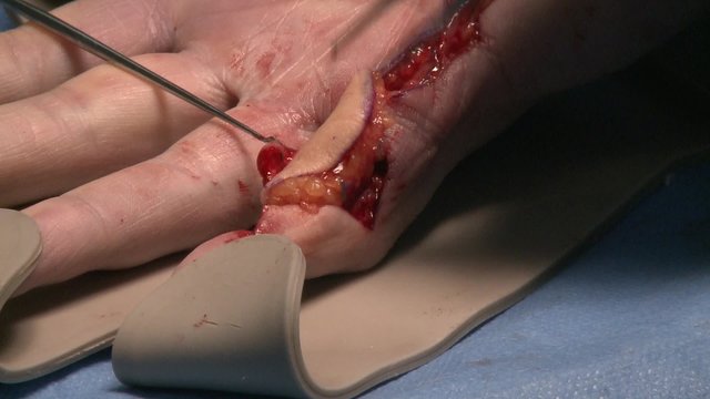 surgery in an operating room/rests an end portion of skin of the forearm
