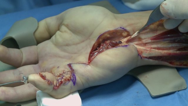 surgery in an operating room/sliding control for the new tendon of the little finger
