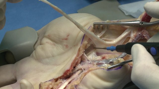surgery in an operating room/separation of the tendon using electrocautery
