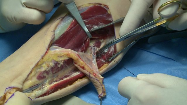 surgery in an operating room/cutting a suture of an artery
